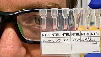Covid-19 antibody test gives results in 20 minutes